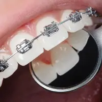Dental-Braces