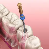 Root-Canal