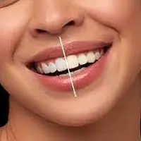 Teeth-Whitening